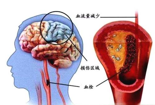 引发脑出血的原因是什么